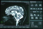 MRI���u�ŎB�e�����]�̖��f�ʉ摜�ł�